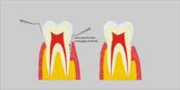 Malattia parodontale - Studio 3 Zeta del Dr. Zozzi